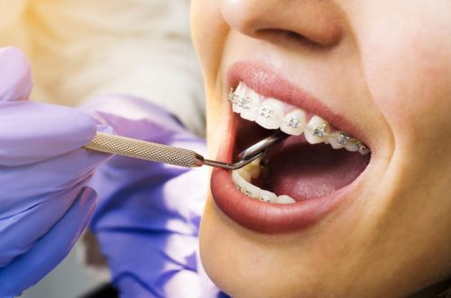 dental braces Hazel Park MI