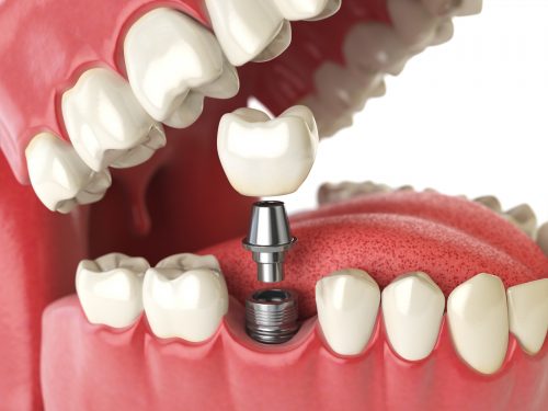 Dental implants Hazel Park MI